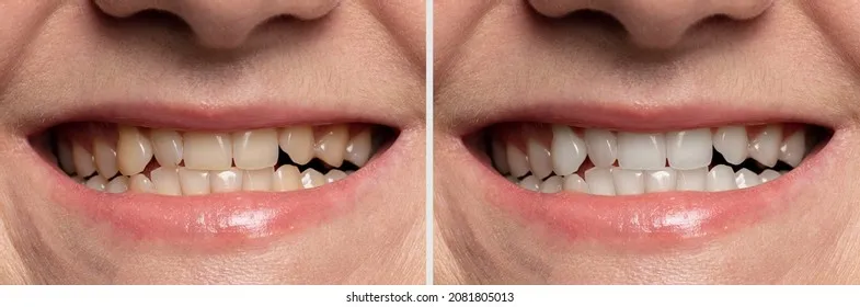 26393 healthy smile after whitening