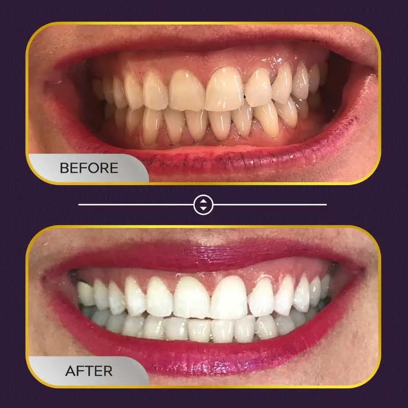 26393 teeth whitening procedure