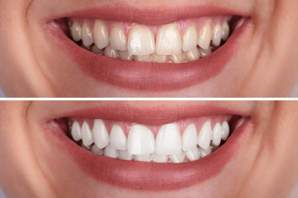 26396 arlington tx teeth whitening options