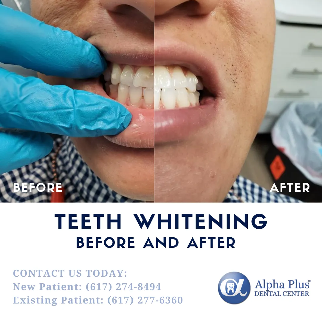 26399 in office teeth whitening