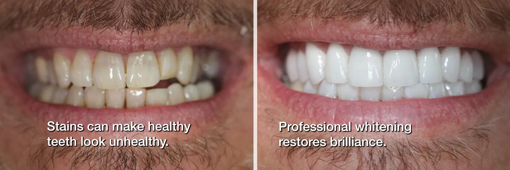 26399 teeth whitening before after