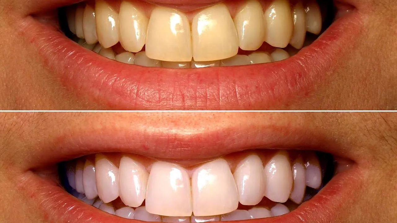 26399 teeth whitening process