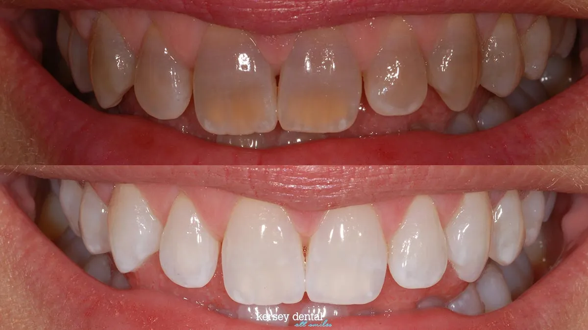 26403 at home whitening trays