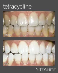 26403 dental bonding