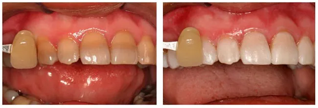 26403 in office bleaching