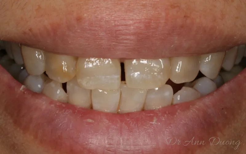 26403 porcelain veneers