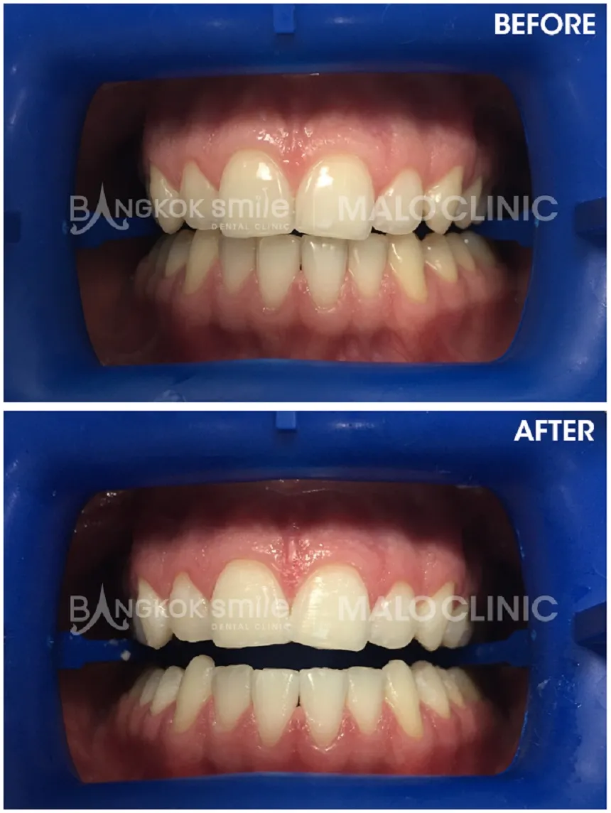 26419 professional whitening