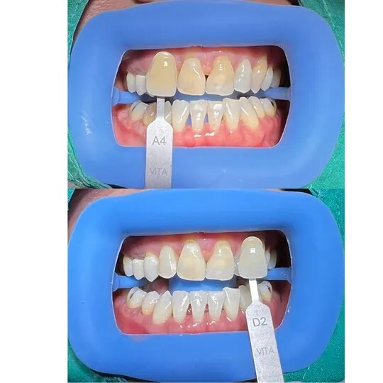 26419 sensitive teeth