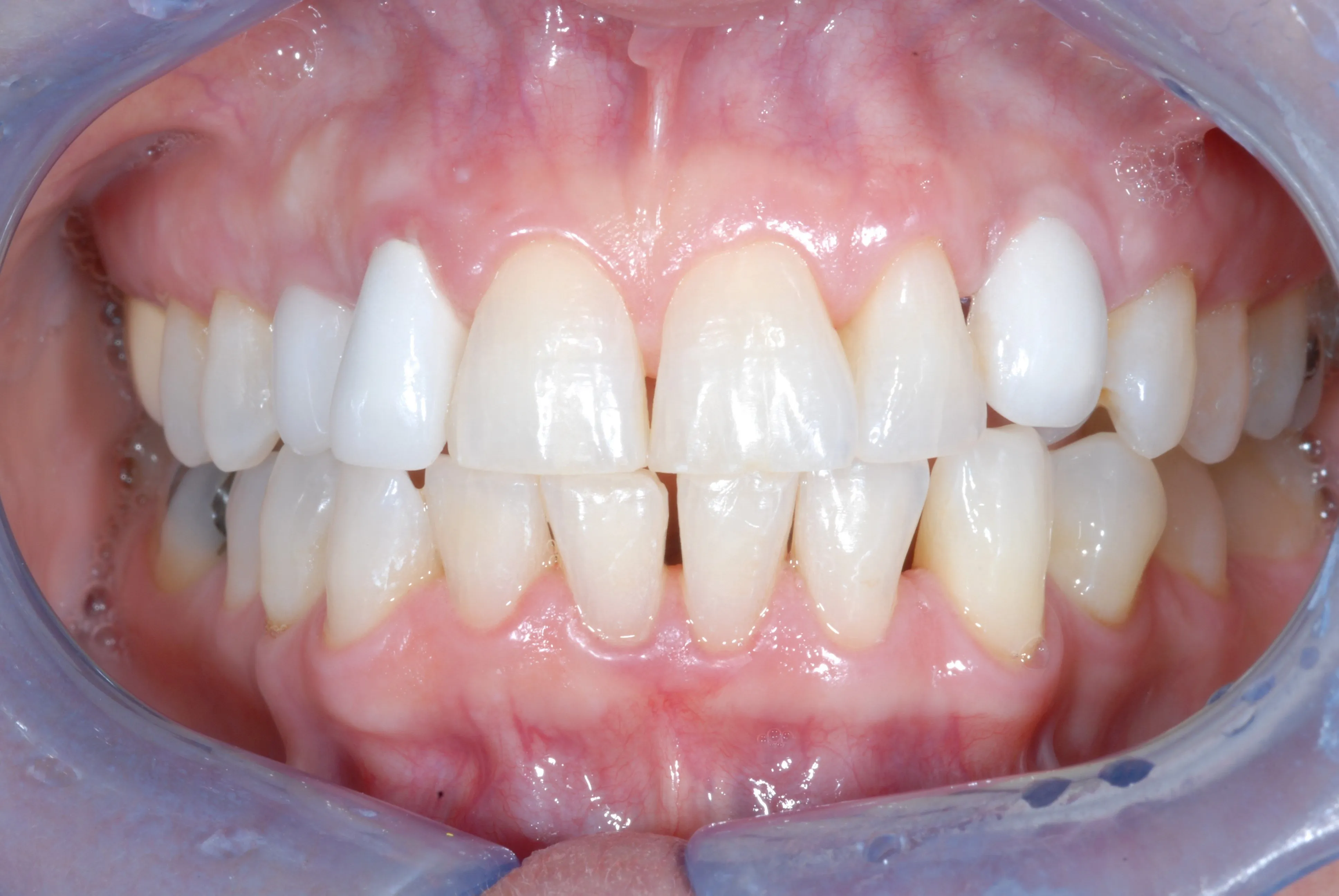 26435 foods to avoid teeth whitening