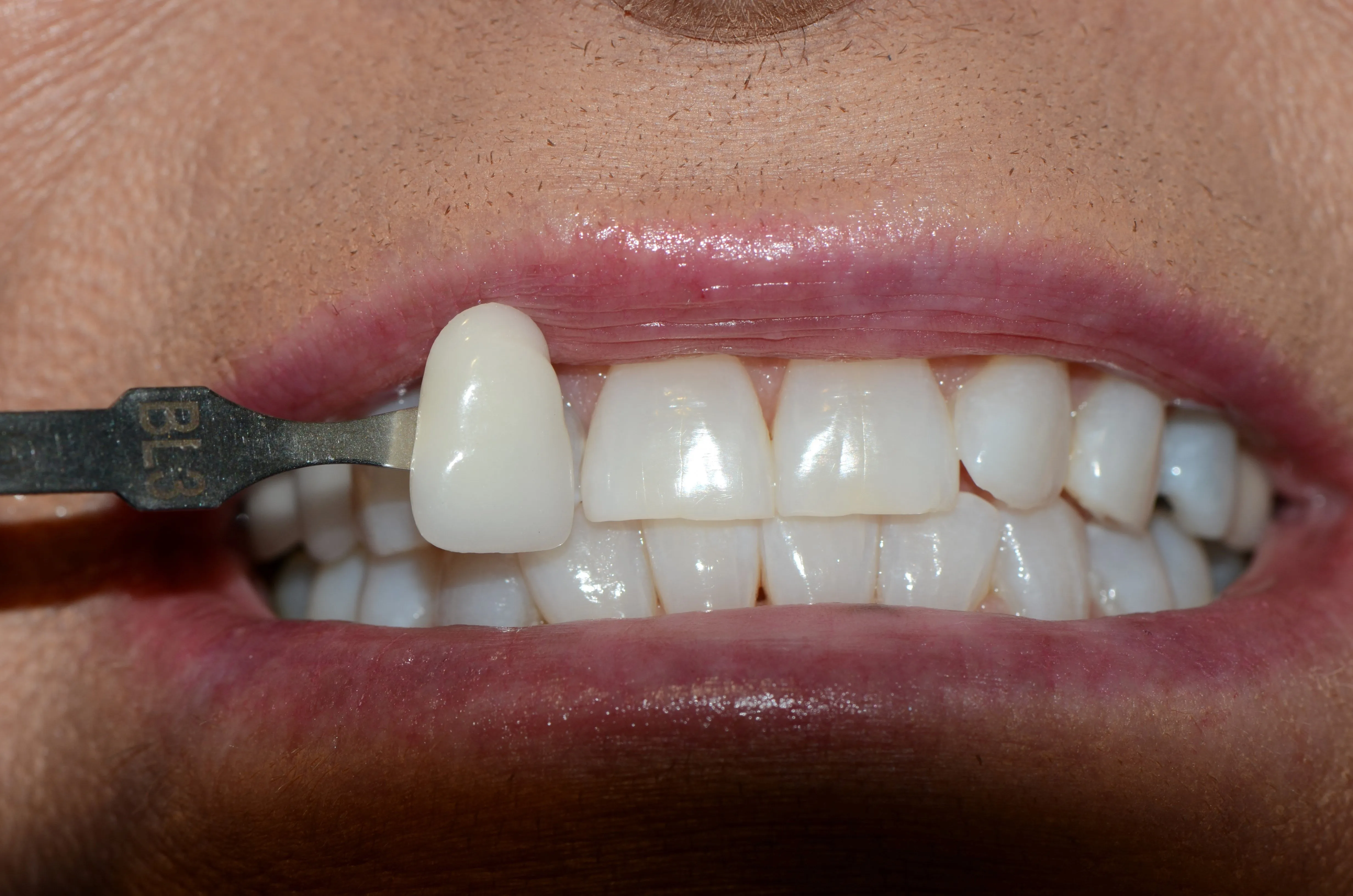 26435 professional teeth whitening