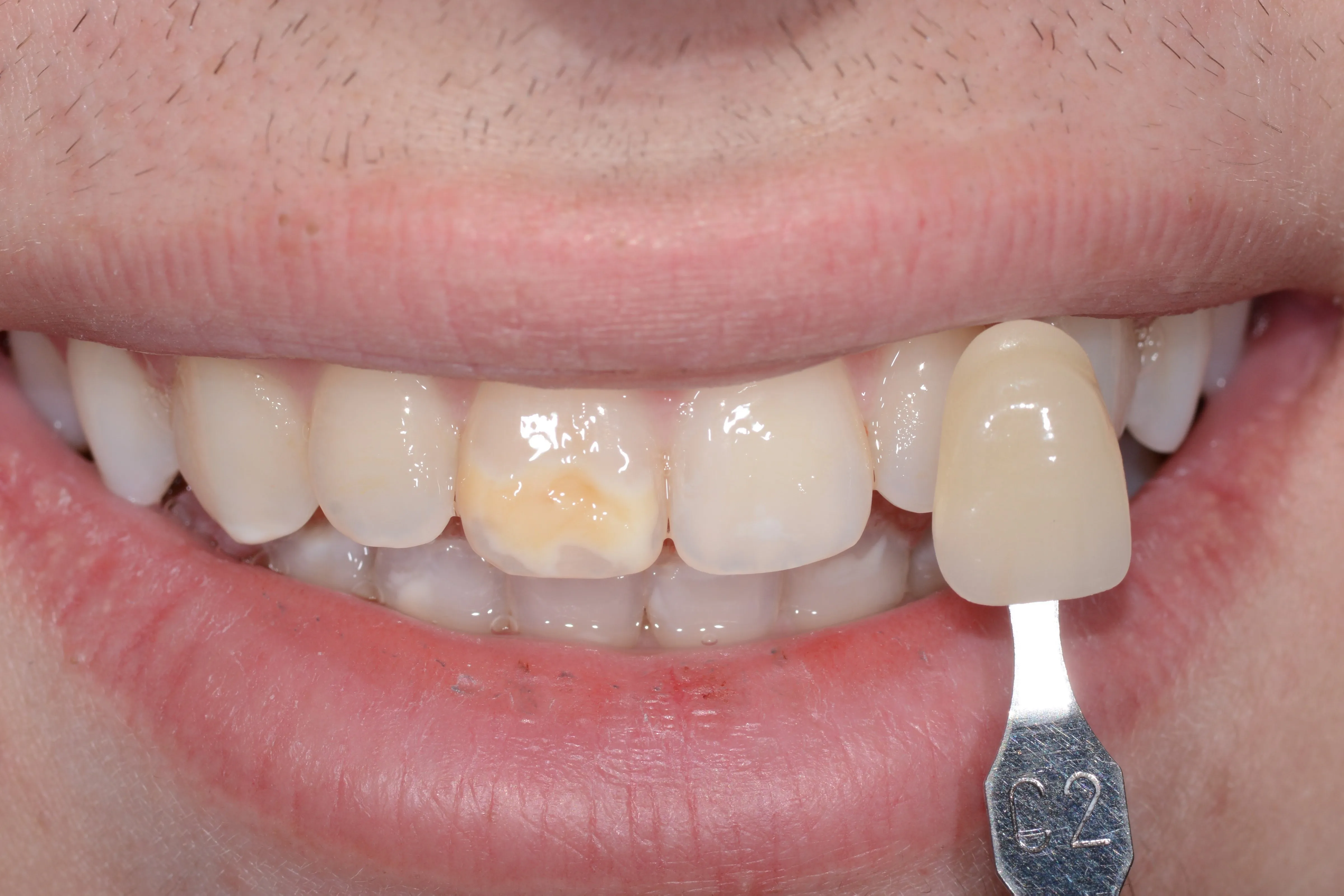 26435 teeth whitening aftercare