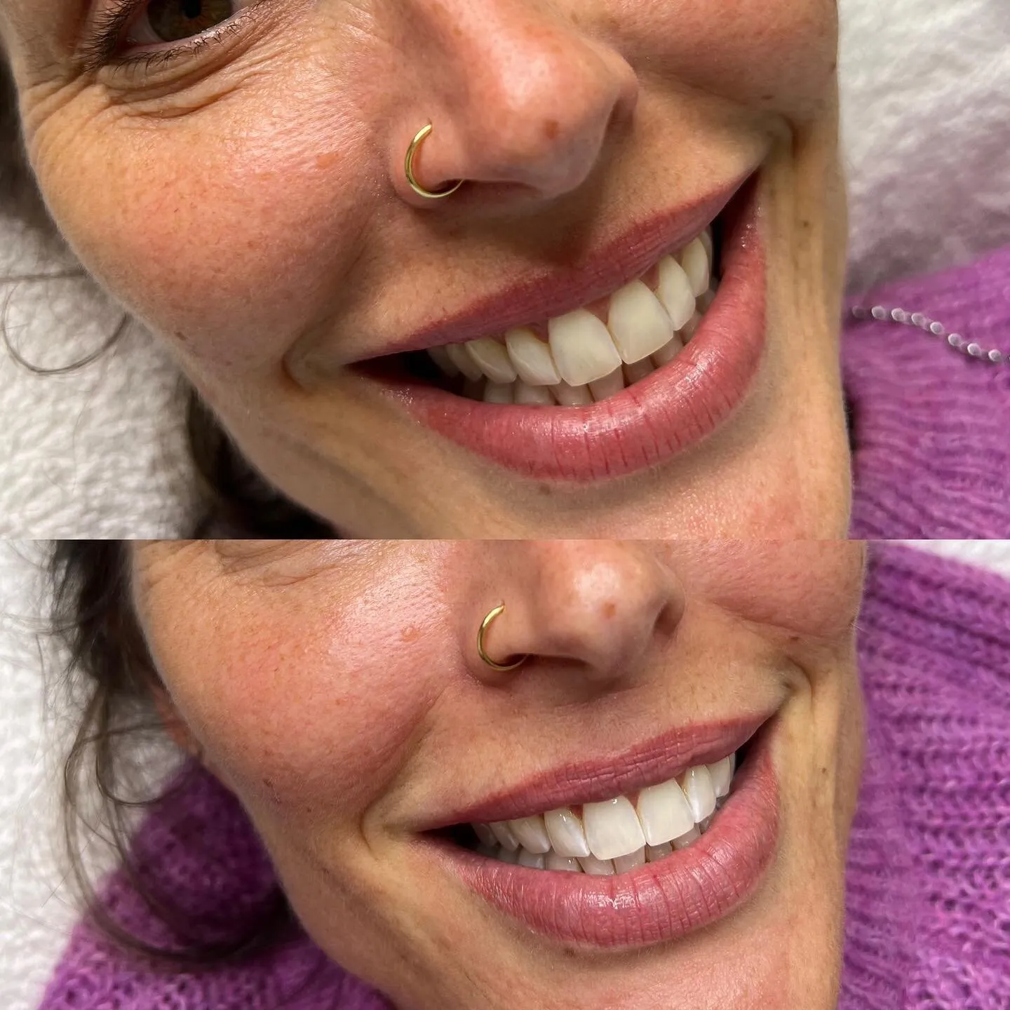 26440 teeth whitening newtownabbey dentist