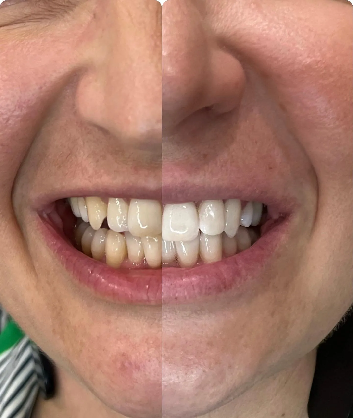 26440 teeth whitening newtownabbey maintenance