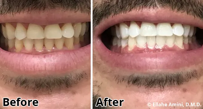 26443 home whitening kit