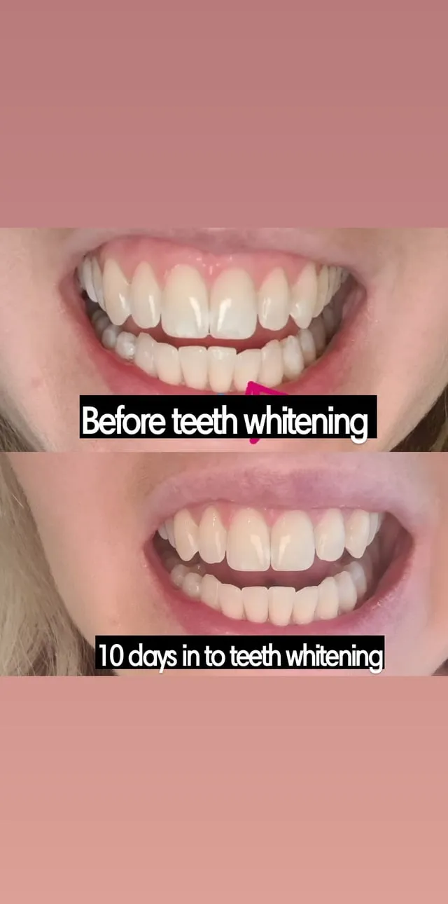 26445 teeth sensitivity