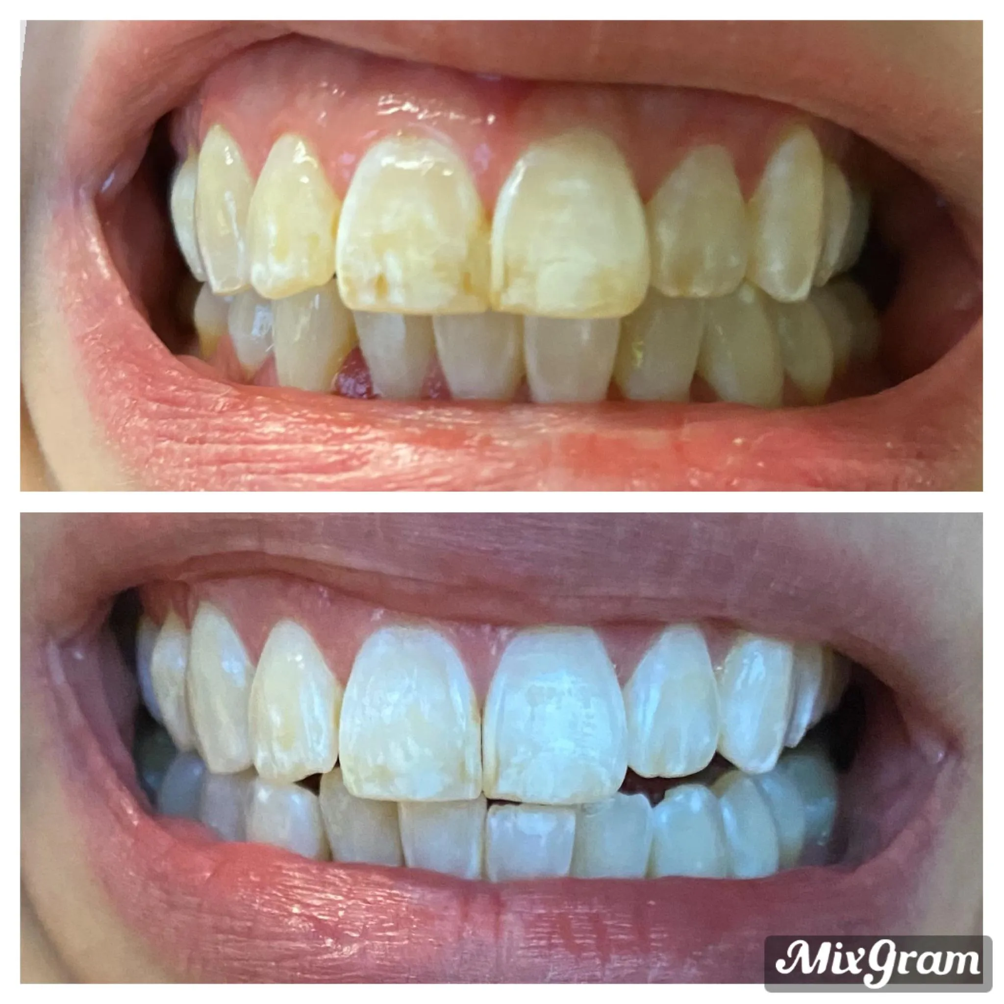 26445 whitening strips application