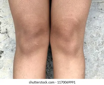26447 dark knees causes