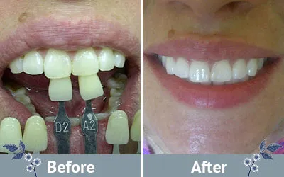 26450 bay plaza teeth whitening patient consultation