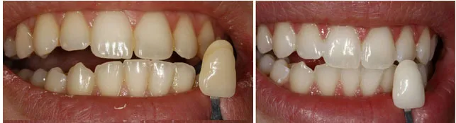 26462 in office teeth whitening