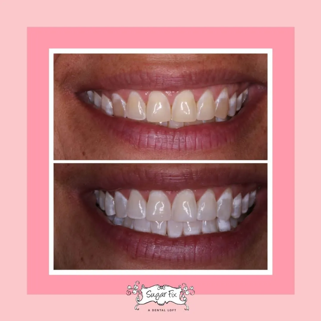 26463 chic delta teeth whitening application