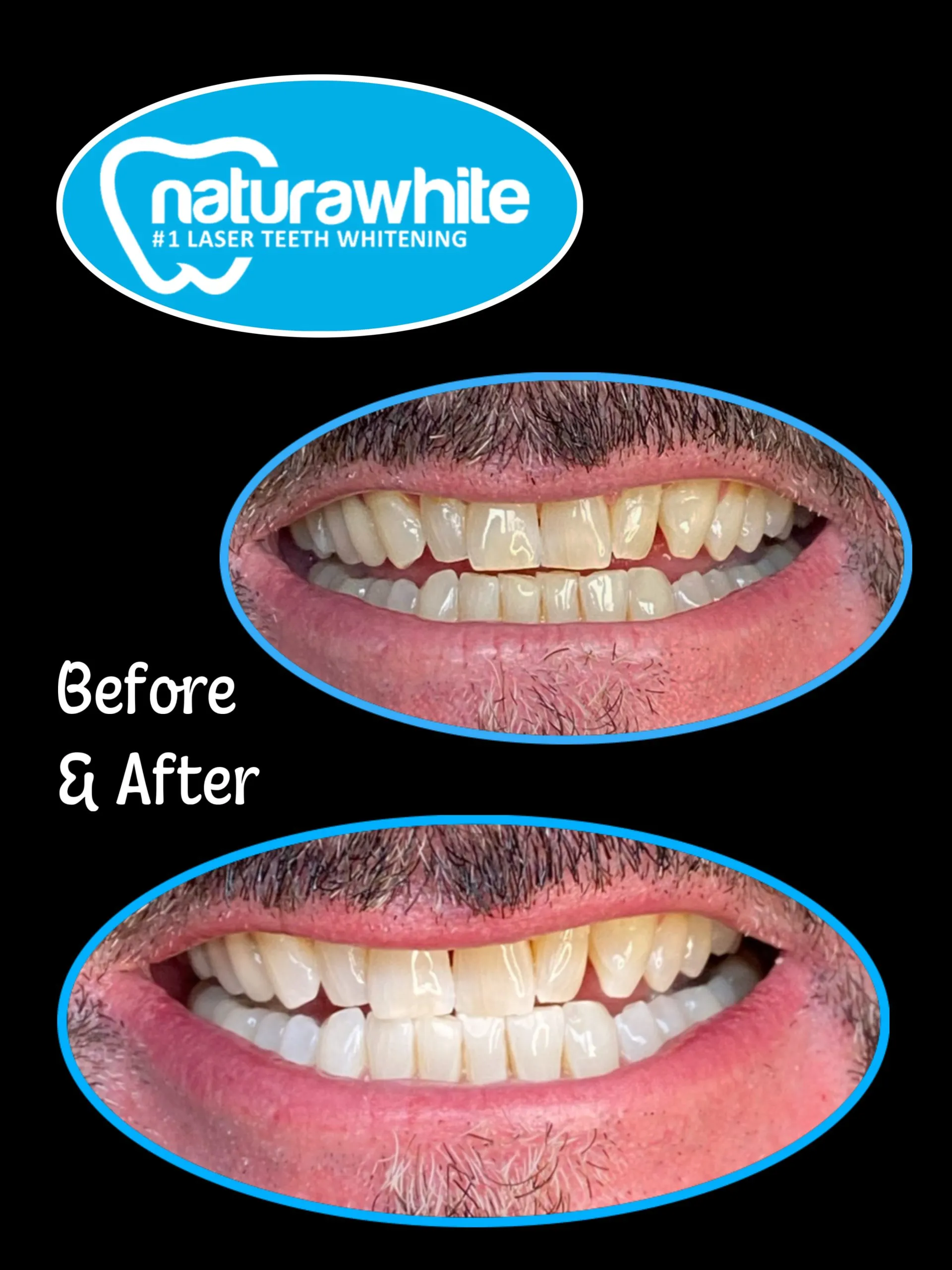 26474 teeth whitening procedure
