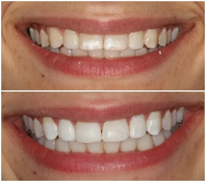 /img/26476-teeth-whitening-options.webp