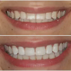 /img/26476-teeth-whitening-options.webp
