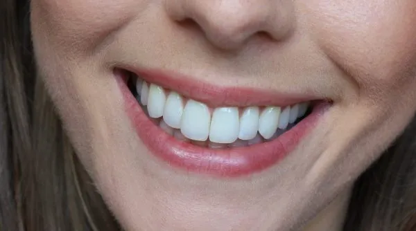 26478 crest whitening strips