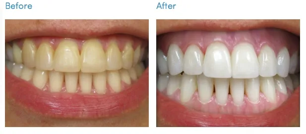 26482 teeth whitening frisco tx types